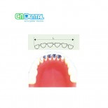 Lingual retainer for mandibular